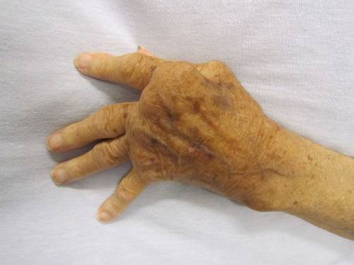 Artrite reumatoide, quali sono i sintomi?